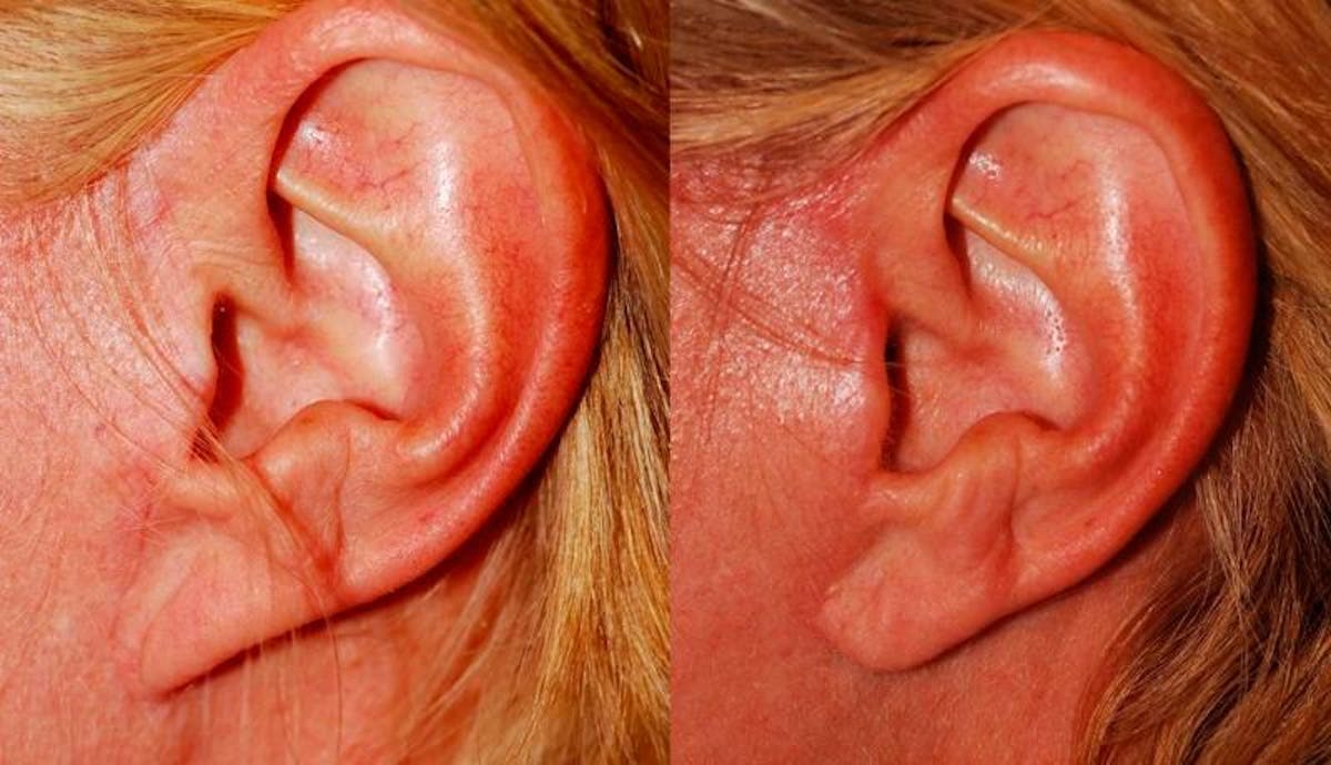 Scar Revision Before & After Gallery - Patient 454791 - Image 1