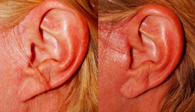 Scar Revision Before & After Gallery - Patient 454791 - Image 1