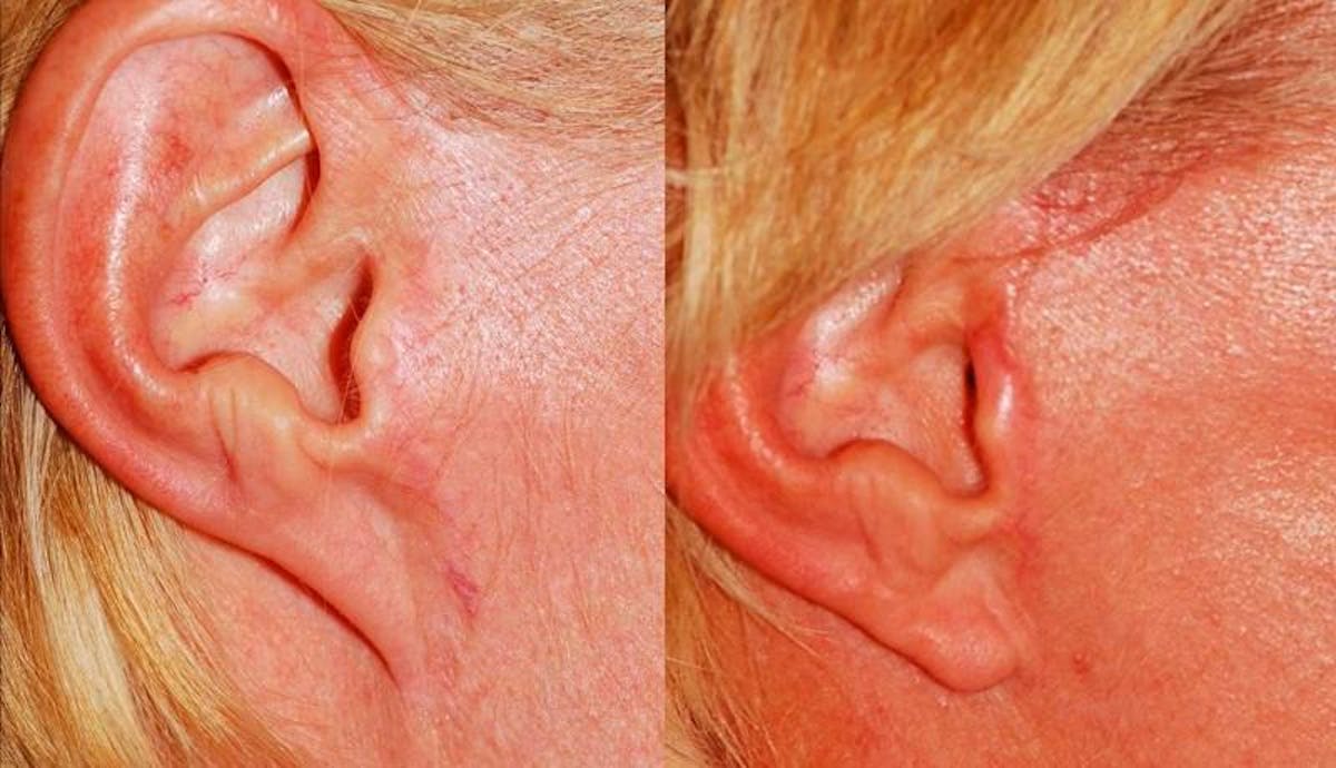 Scar Revision Before & After Gallery - Patient 454791 - Image 2