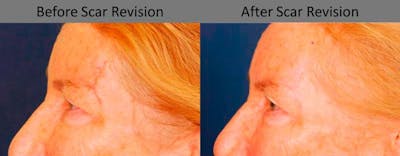 Scar Revision Before & After Gallery - Patient 416968 - Image 1
