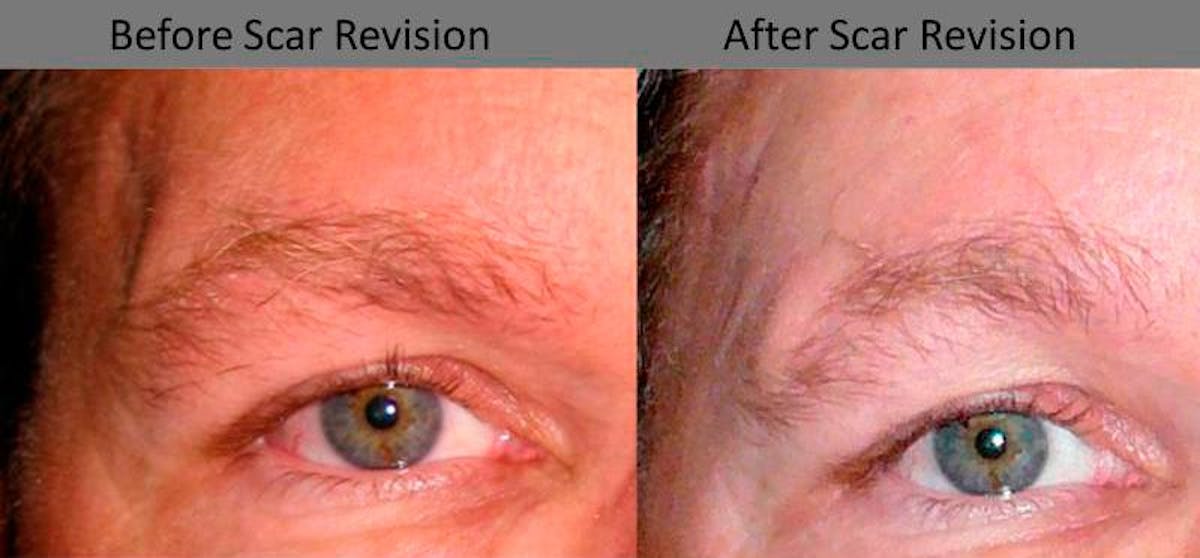Scar Revision Before & After Gallery - Patient 596456 - Image 1