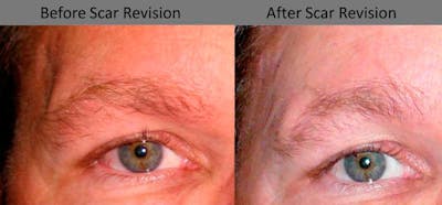 Scar Revision Before & After Gallery - Patient 596456 - Image 1