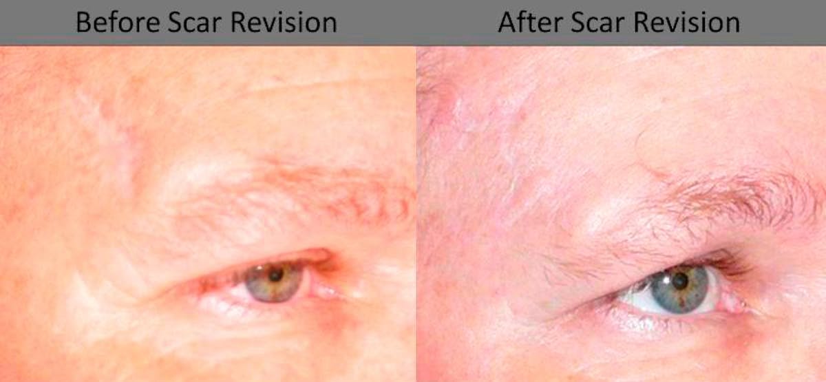 Scar Revision Before & After Gallery - Patient 596456 - Image 2