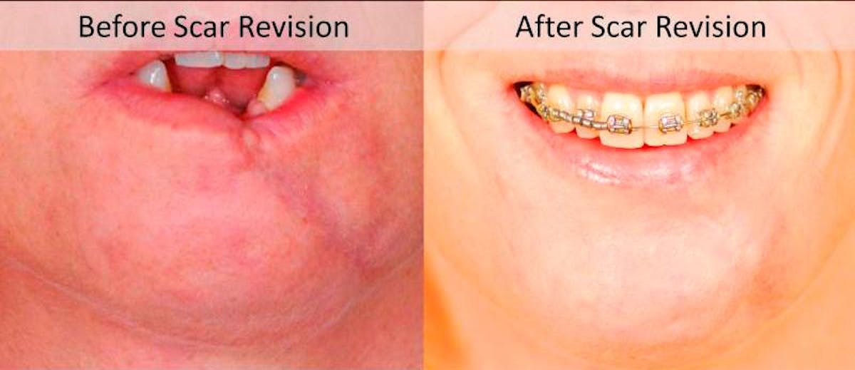 Scar Revision Before & After Gallery - Patient 255378 - Image 1