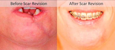 Scar Revision Before & After Gallery - Patient 255378 - Image 1