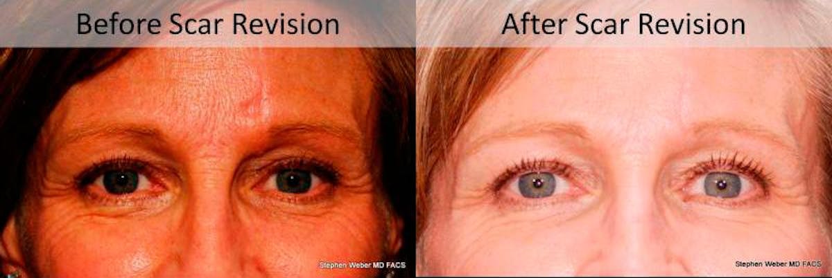 Scar Revision Before & After Gallery - Patient 898556 - Image 1