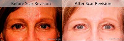 Scar Revision Before & After Gallery - Patient 898556 - Image 1