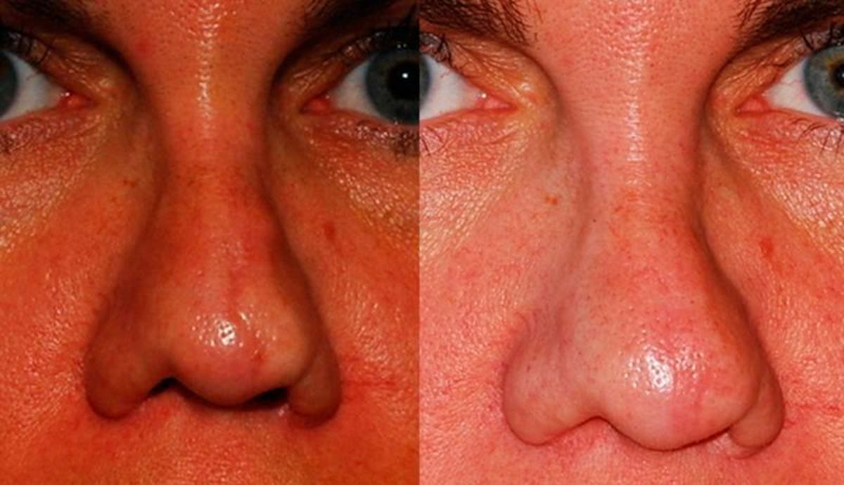 Scar Revision Before & After Gallery - Patient 699490 - Image 1