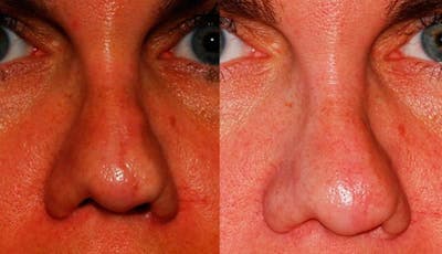 Scar Revision Before & After Gallery - Patient 699490 - Image 1