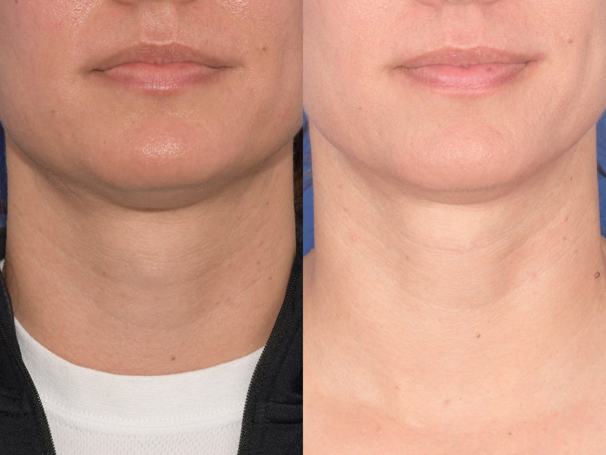 Tracheal Shave Before & After Gallery - Patient 152642 - Image 1