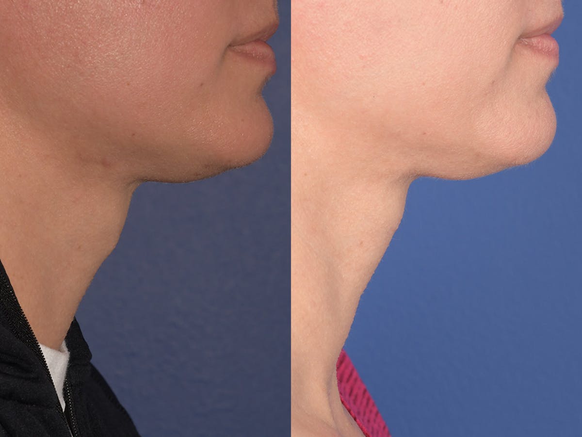 Tracheal Shave Before & After Gallery - Patient 152642 - Image 2