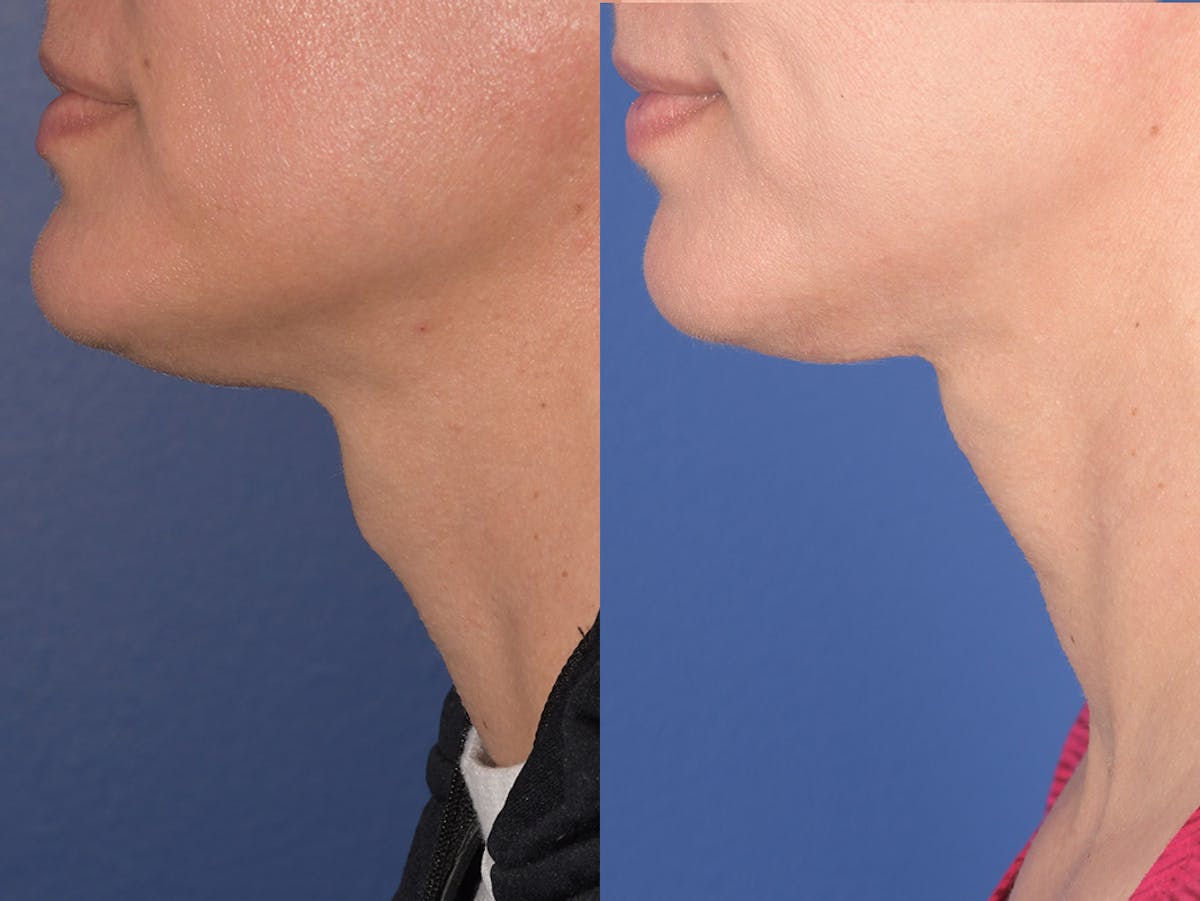 Tracheal Shave Before & After Gallery - Patient 152642 - Image 3