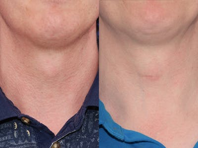 Tracheal Shave Before & After Gallery - Patient 100706 - Image 1