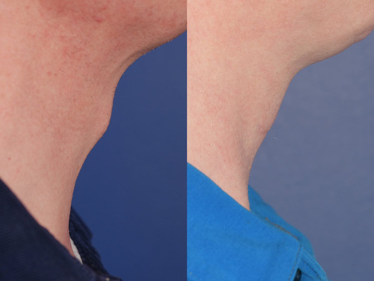 Tracheal Shave Before & After Gallery - Patient 100706 - Image 2