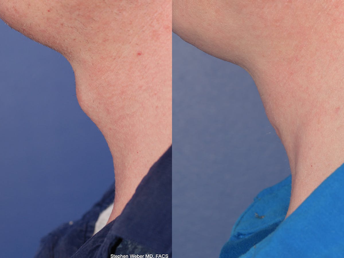 Tracheal Shave Before & After Gallery - Patient 100706 - Image 3