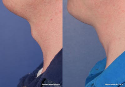 Tracheal Shave Before & After Gallery - Patient 280703 - Image 1