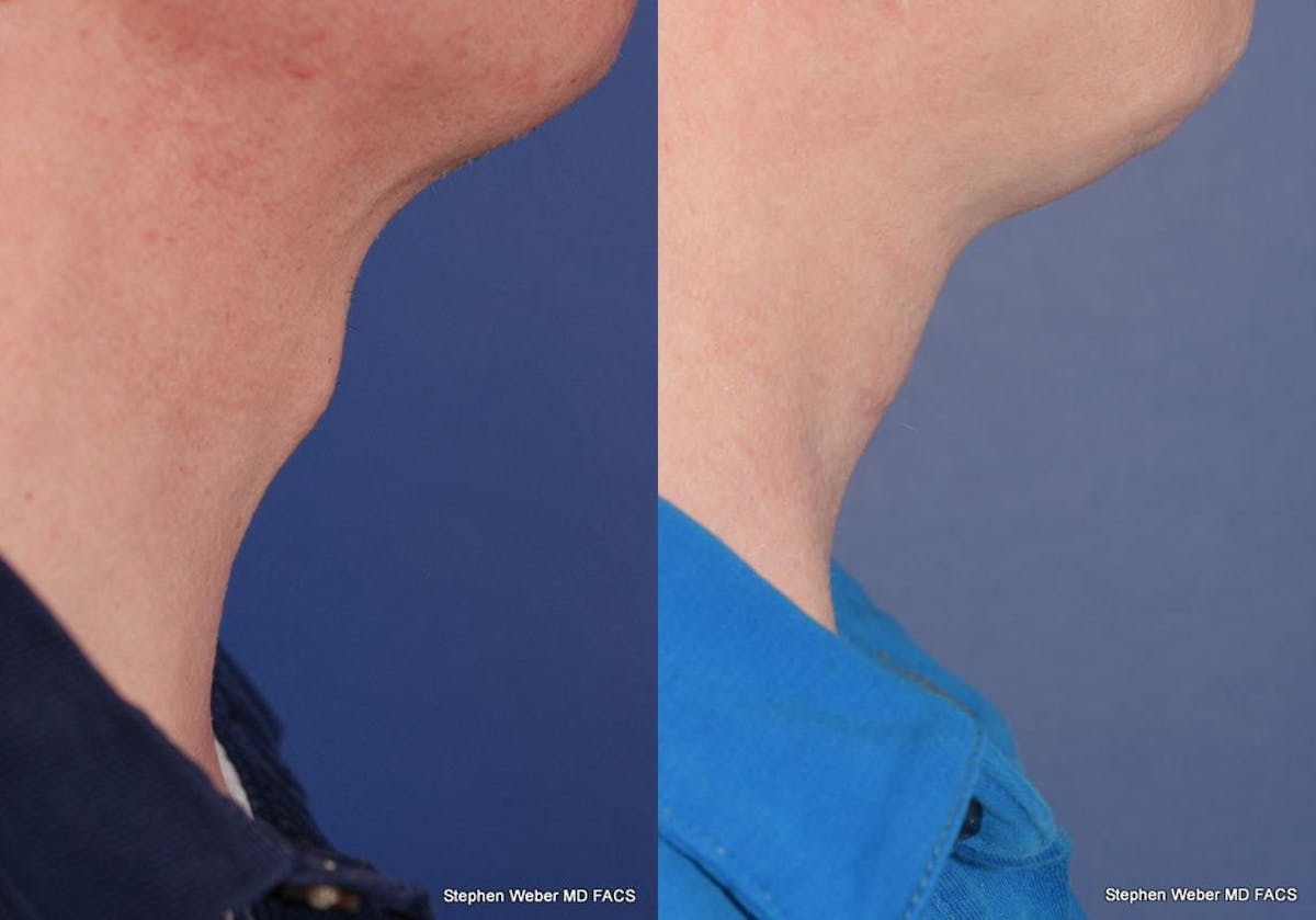 Tracheal Shave Before & After Gallery - Patient 280703 - Image 2