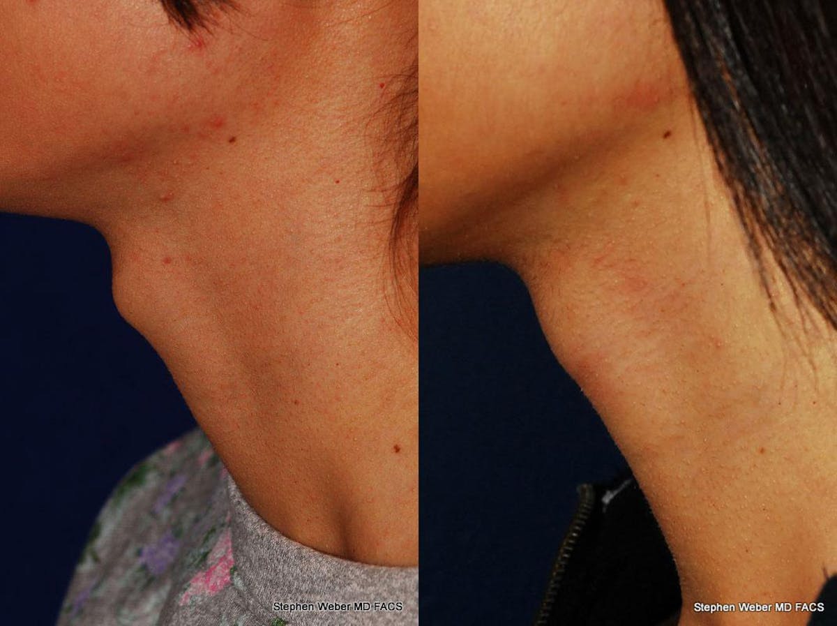 Tracheal Shave Before & After Gallery - Patient 242759 - Image 1