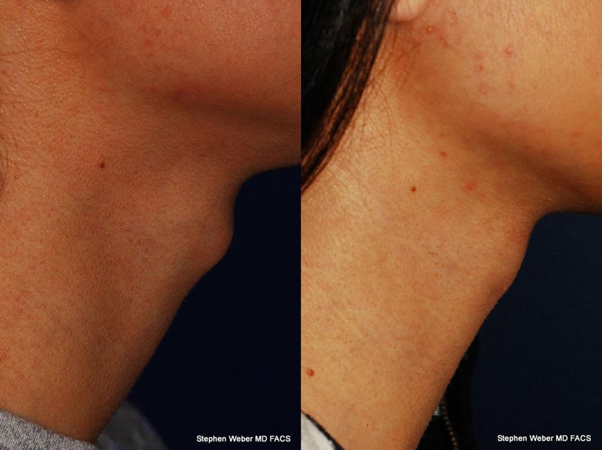 Tracheal Shave Before & After Gallery - Patient 242759 - Image 2