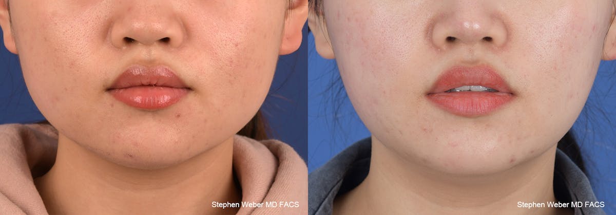 Botox Before & After Gallery - Patient 113600 - Image 1