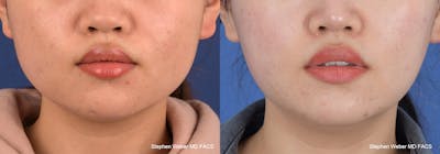 Botox Before & After Gallery - Patient 113600 - Image 1