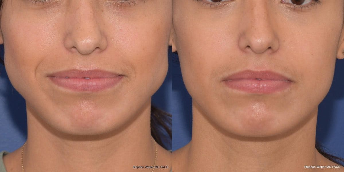 Botox Before & After Gallery - Patient 382005 - Image 1