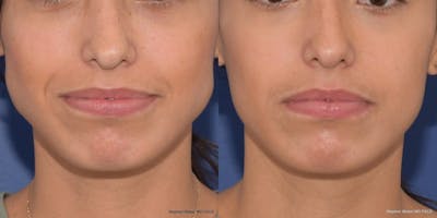 Botox Before & After Gallery - Patient 382005 - Image 1