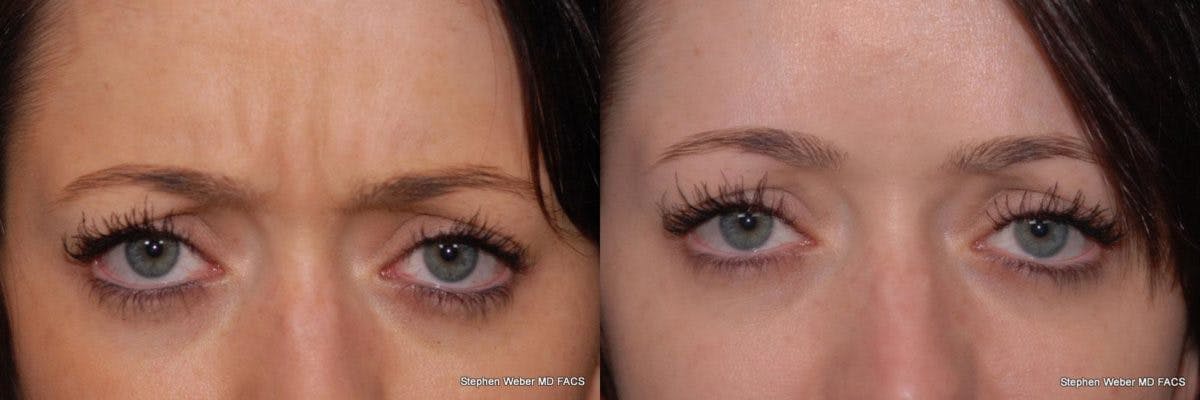 Botox Before & After Gallery - Patient 170052 - Image 1