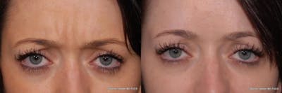Botox Before & After Gallery - Patient 170052 - Image 1