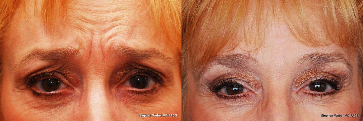 Botox Before & After Gallery - Patient 244256 - Image 1