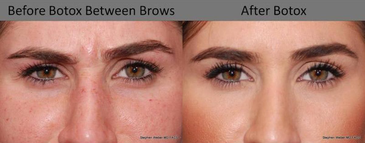 Botox Before & After Gallery - Patient 185254 - Image 1