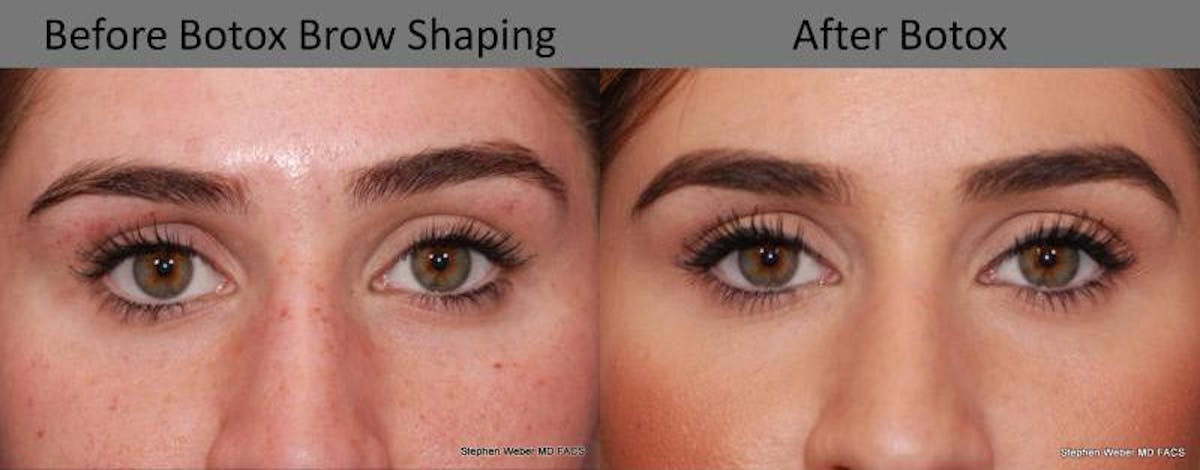 Botox Before & After Gallery - Patient 185254 - Image 2