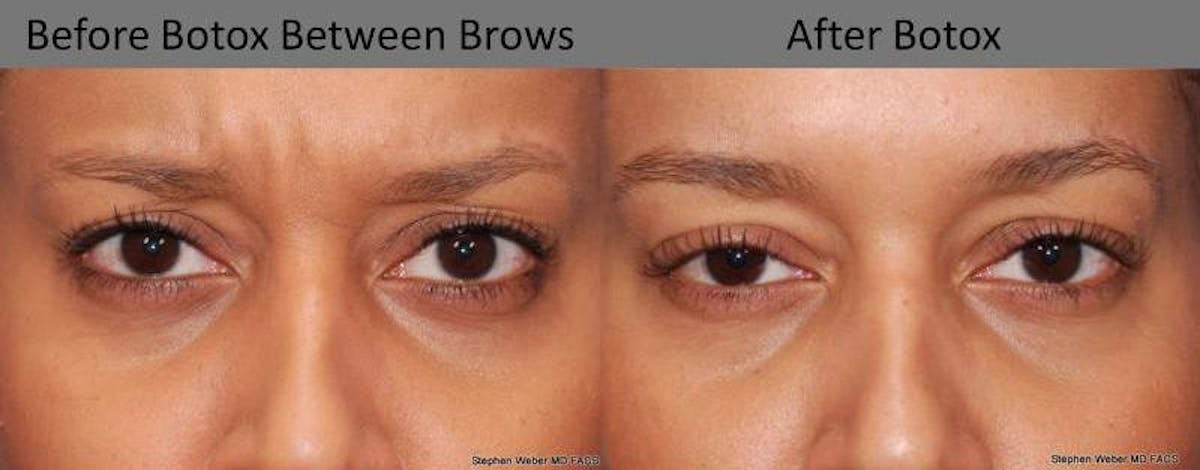 Botox Before & After Gallery - Patient 389783 - Image 1