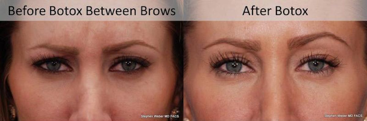 Botox Before & After Gallery - Patient 137988 - Image 1