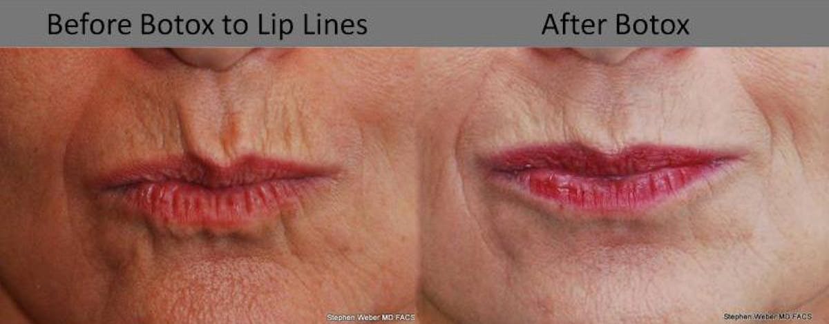 Botox Before & After Gallery - Patient 409085 - Image 1