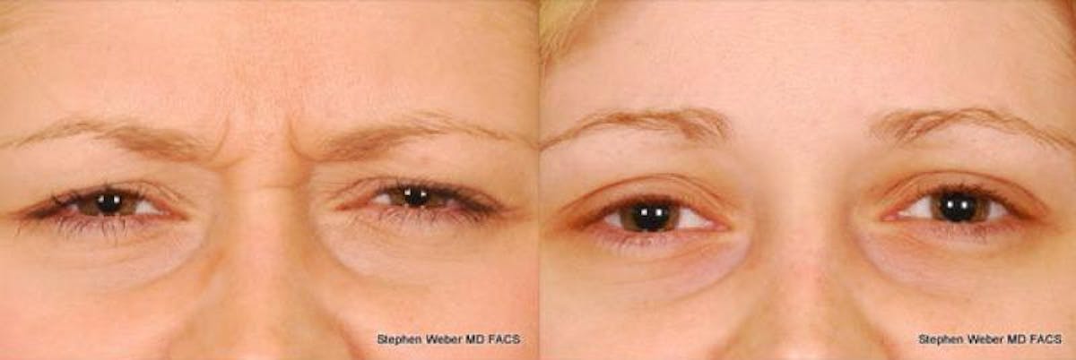 Botox Before & After Gallery - Patient 929662 - Image 1