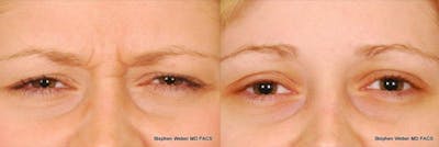 Botox Before & After Gallery - Patient 929662 - Image 1