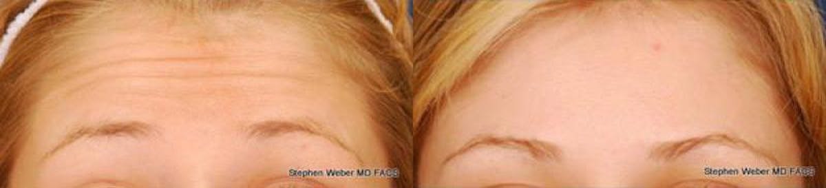 Botox Before & After Gallery - Patient 856149 - Image 1
