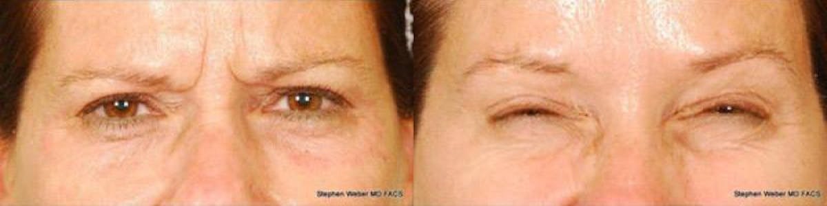 Botox Before & After Gallery - Patient 407428 - Image 1