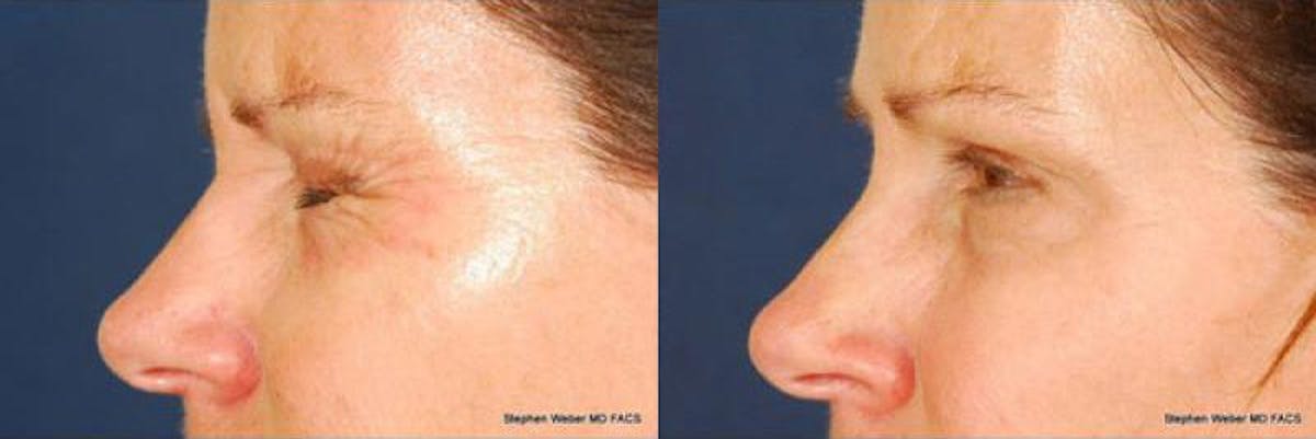 Botox Before & After Gallery - Patient 407428 - Image 2