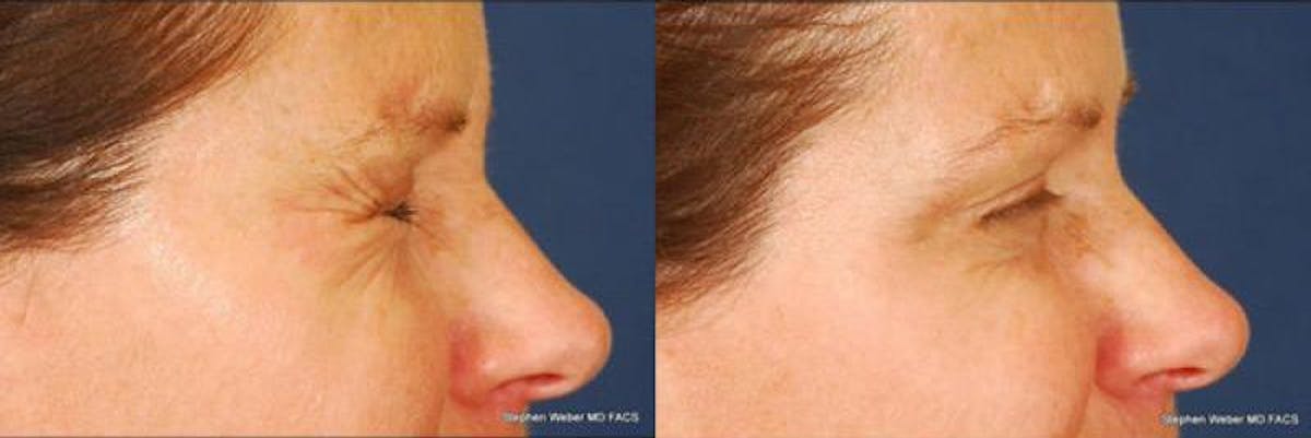 Botox Before & After Gallery - Patient 407428 - Image 3