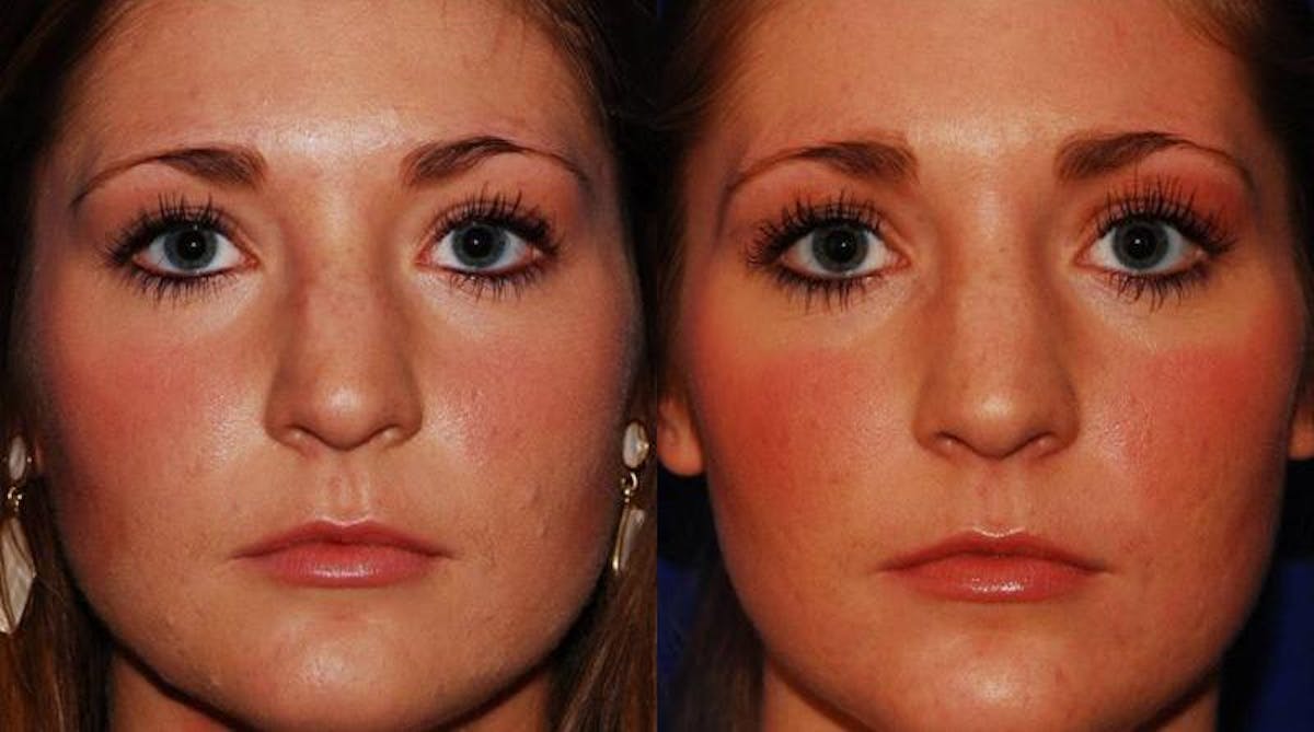 Botox Before & After Gallery - Patient 320101 - Image 1