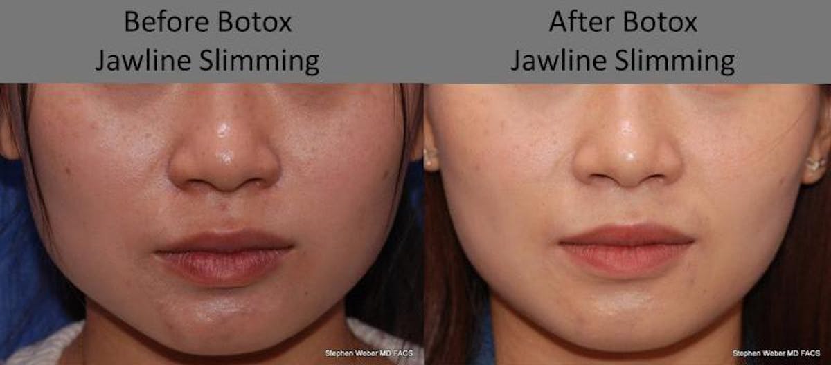 Botox Before & After Gallery - Patient 321154 - Image 1