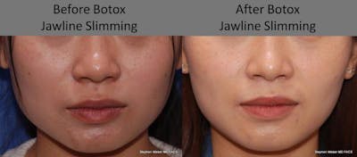 Botox Before & After Gallery - Patient 321154 - Image 1