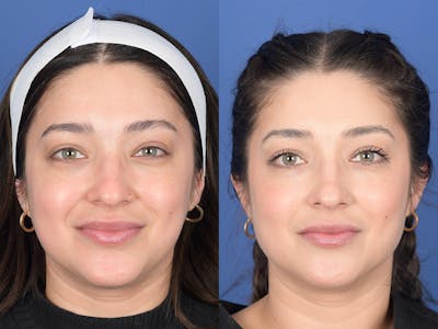 Dermal Filler Before & After Gallery - Patient 154663 - Image 1