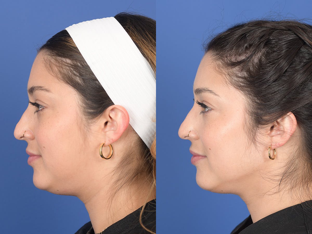 Dermal Filler Before & After Gallery - Patient 154663 - Image 2
