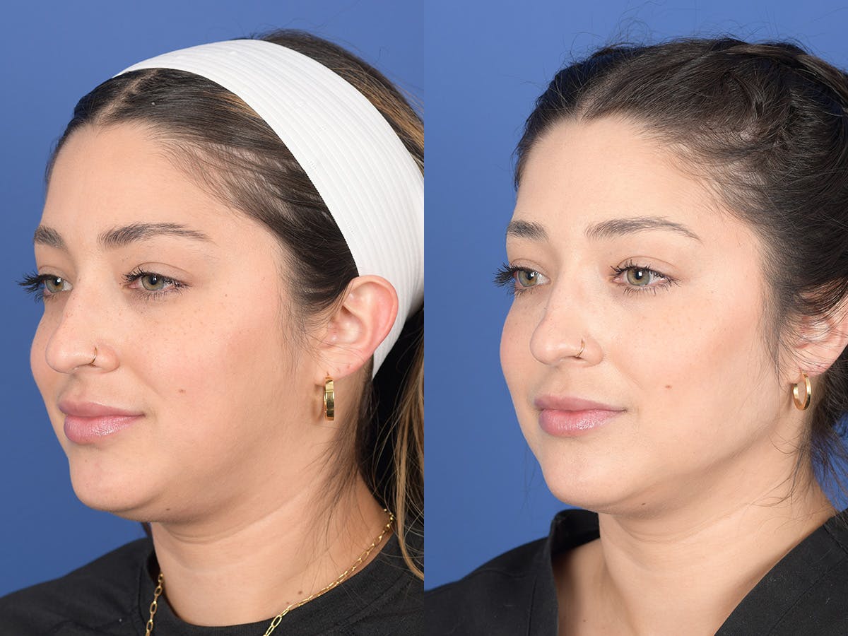 Dermal Filler Before & After Gallery - Patient 154663 - Image 3