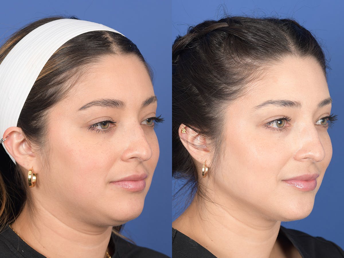 Dermal Filler Before & After Gallery - Patient 154663 - Image 4