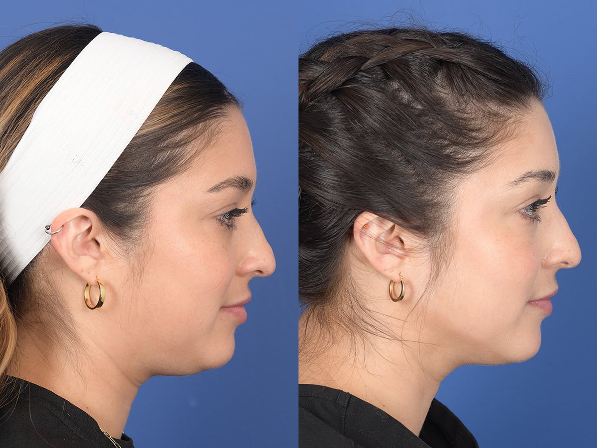 Dermal Filler Before & After Gallery - Patient 154663 - Image 5