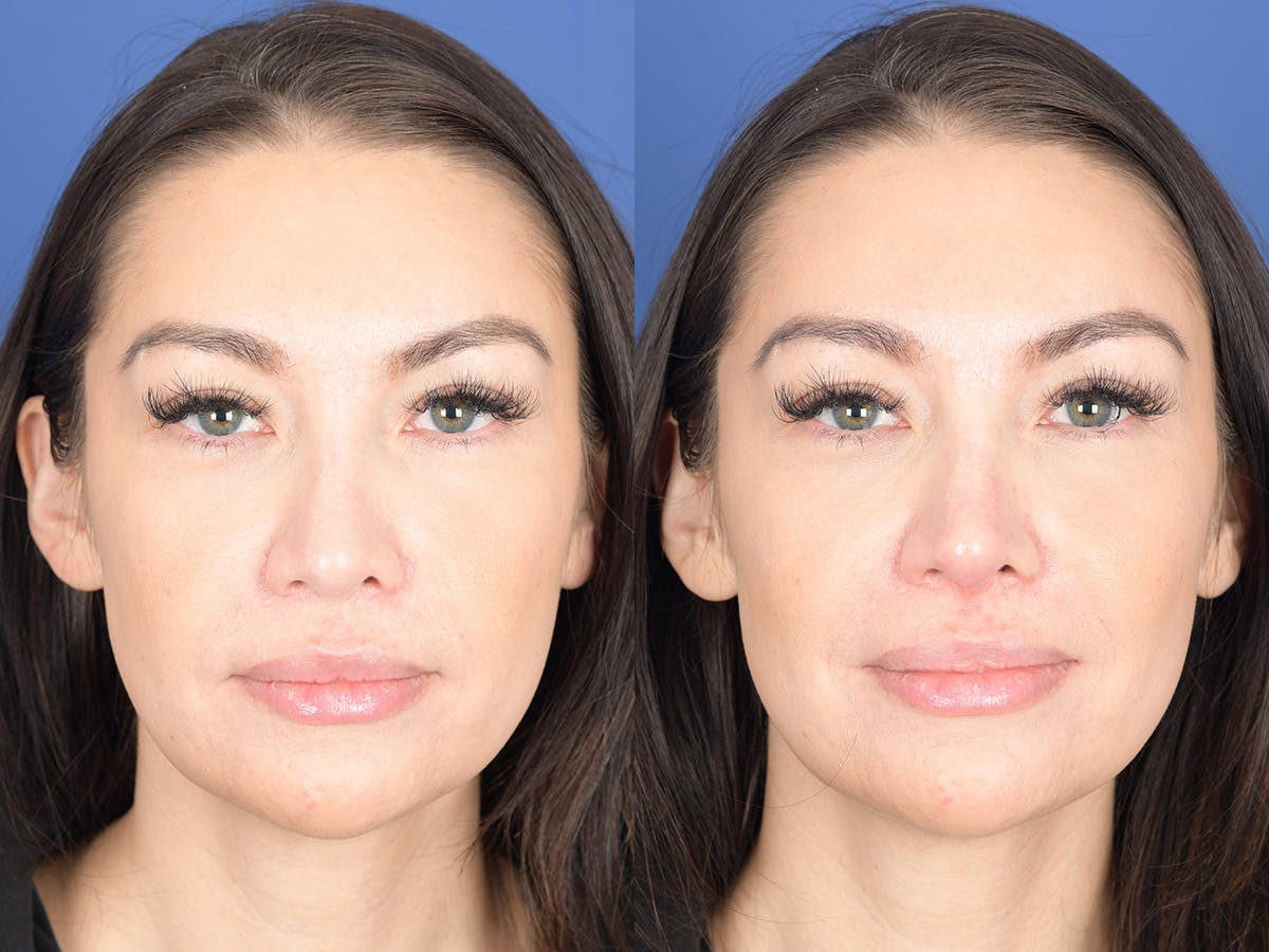 Dermal Filler Before & After Gallery - Patient 403117 - Image 1